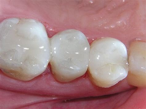 Holes In Teeth That Aren T Cavities Teethwalls