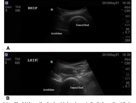 Figure 1 From Ultrasound In Emergency Medicine Bedside Ultrasound For