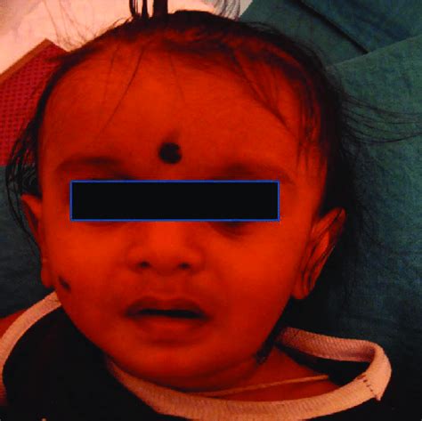 Clinical Photograph Showing Diffuse Swelling On The Left Lower Third Of