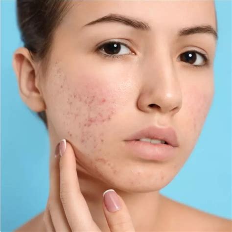 Is Acne Scarring Permanent How To Treat And Reduce The Appearance Of