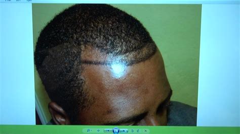 There is a korean proverb, the meaning of 'repair the barn after the cow is lost is that it is important to keep it before it is lost, it's the same for hair. Black Man Hairline Transplant 1000 Hair Grafts Result 1 ...