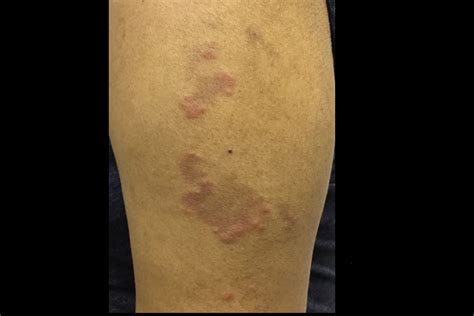 Derm Dx Itchy Rash On Outer Arm Clinical Advisor