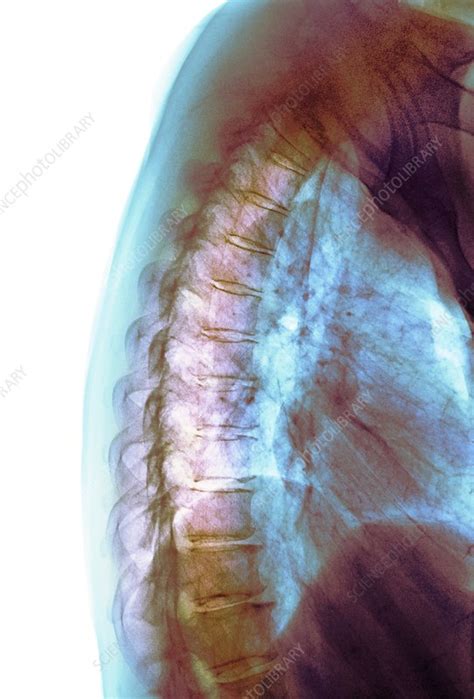 Osteoarthritis Of The Spine X Ray Stock Image C0387688 Science