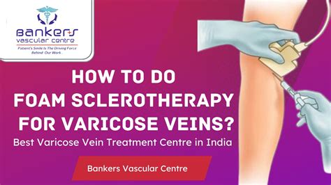 Foam Sclero Therapy For Varicose Veins Bankers Vascular Centre