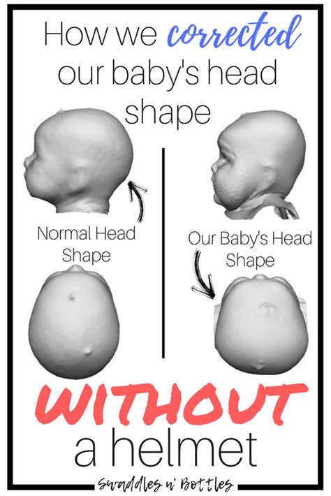 How To Prevent Flat Head Syndrome And Avoid The Baby Helmet Artofit