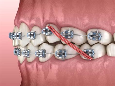 Corrective Braces For An Overjet Henry Orthodontics Pinehurst North Carolina