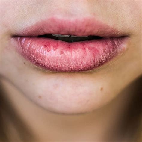 Dry Swollen Lips In Morning Lipstutorial Org