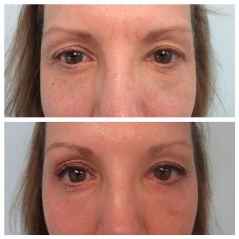 Eye Rejuvenation In Chevy Chase Md And Washington Dc The West Institute