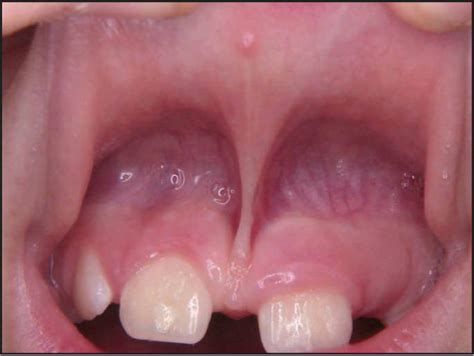 A Maxillary Median Labial Frenum With A Low Insertion Documents