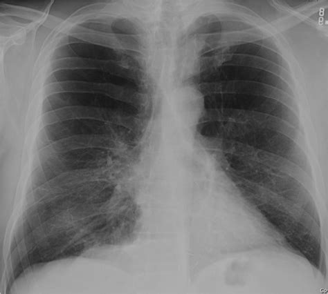 Copd Bullae Chest X Ray Asthma Lung Disease