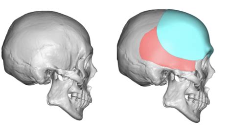 Male Custom Forehead Brow Bone Implant Design Side View Dr Barry Eppley