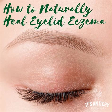 What are the causes of eyelid eczema. How to Naturally Heal Eyelid Eczema | It's an Itchy Little ...