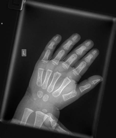 Normal Child Wrist X Ray