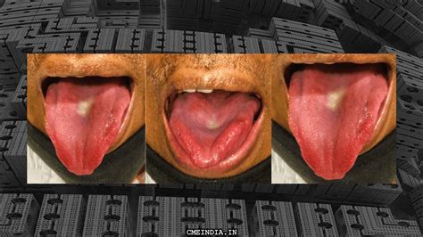 Redness On The Sides Of Tongue What Is The Diagnosis Cme India