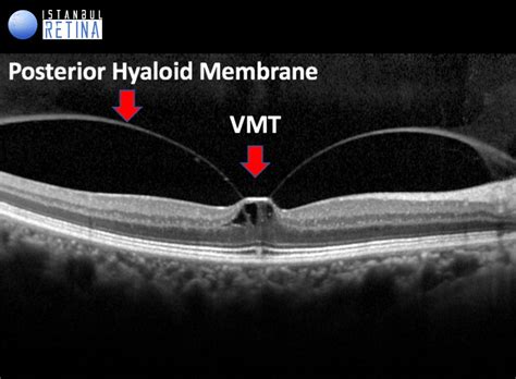 Posterior Vitreous Detachment And Vitreomacular Adhesion Oct Club