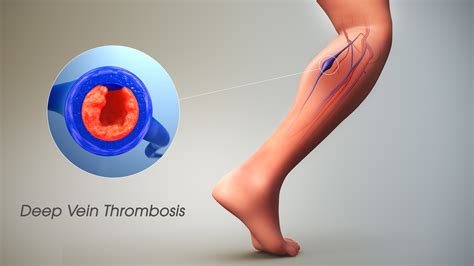 Great Deep Vein Thrombosis Dvt Right Now BUTN
