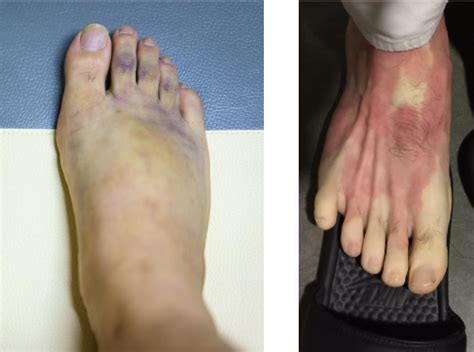 Chilblains And Raynauds Toes Turning Bluered In Winter Holistic