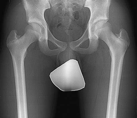 Pelvic Radiograph At 5 Months After Initial Visit Showing The Narrowing