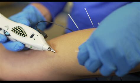 dry needling foundation physical therapy