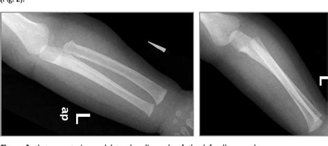 Pdf Pulled Elbow Syndrome In Infants Below 2 Years Of Age A Rare