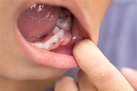 What Is A Tooth Abscess Hurst Pediatric Dentistry