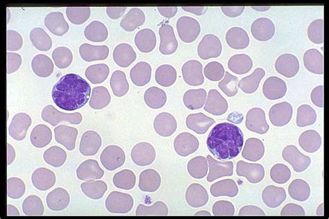 Acute Leukemia T Cell All Acute Lymphoblastic Leukemia