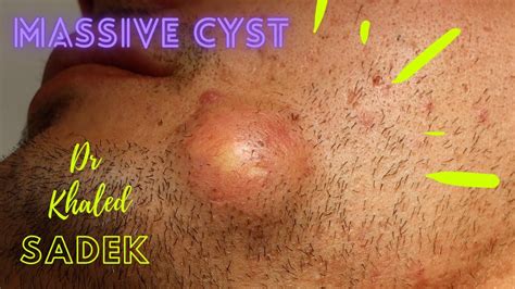 Massive Face Cyst Dr Khaled Sadek LipomaCyst Com Pimple Popping Videos