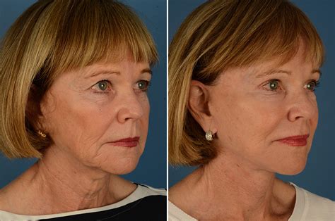 The Uplift Lower Face And Neck Lift Photos Naples Fl Patient 23075