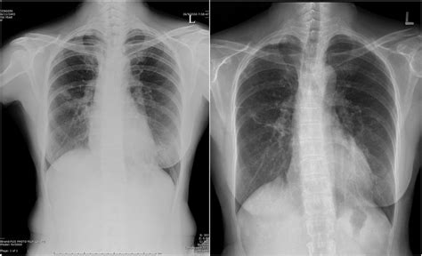 Chest Radiography At The Time Of Diagnosis Shows Opacities At The Right