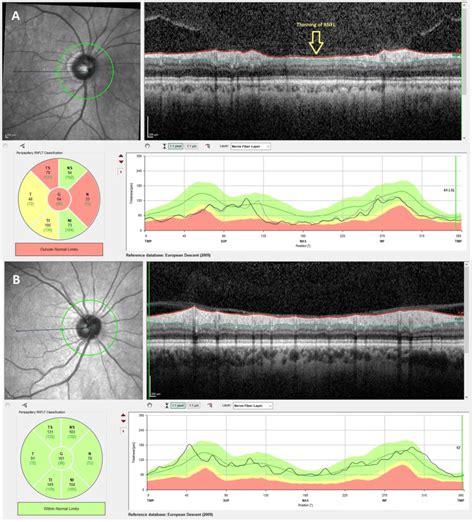 Measurement Of The Retina Nerve Fiber Layer RNFL Thickness A RNFL