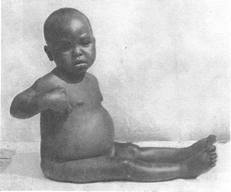 Kwashiorkor In Africa Abstract Europe Pmc