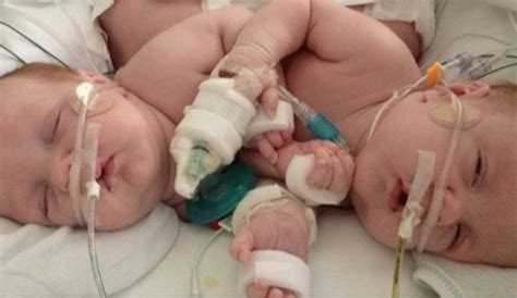 Conjoined Twins Undergo Major Surgery In Texas Are Separated