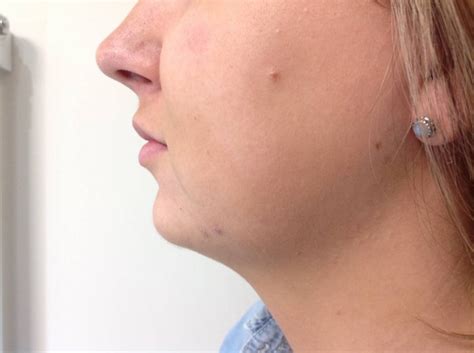 Chin Correction Perfect Skin Solutions