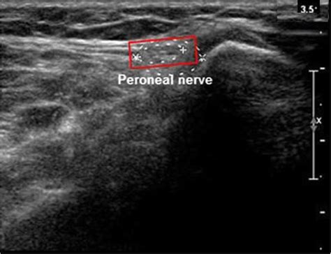 Role Of Superficial Peroneal Sensory Potential And High Resolution