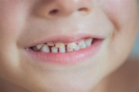 Baby Teeth Guide What To Expect Milk Teeth Care And Problems