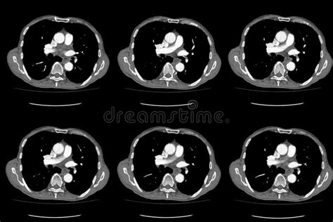 Computed Tomography Ct Whole Abdomen In Axial Part Four Stock Image