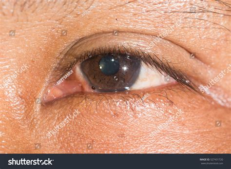 Close Conjunctival Foreign Body During Eye Stock Photo 527431720