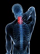 頸椎病的正規治療 - 每日頭條