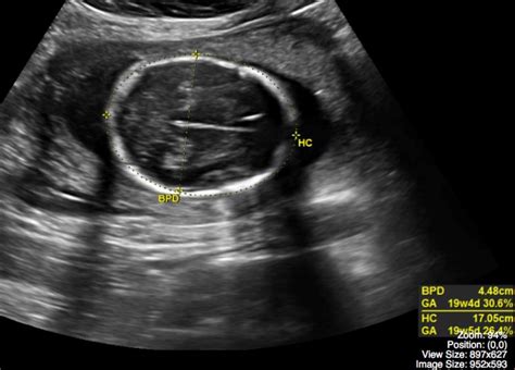 Fetal Head Ultrasound Measurements Hot Sex Picture