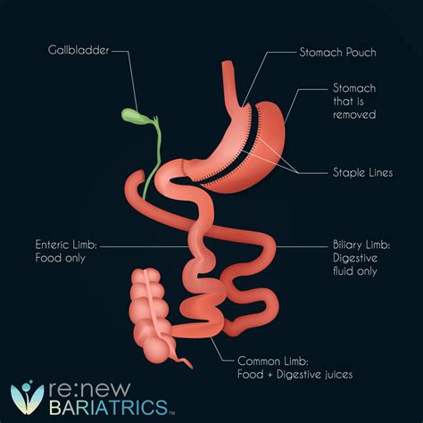 Gastric Bypass Vs Duodenal Switch Which Is Best Expected Weight Loss