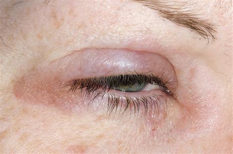 Eyelid Swelling Due To Allergy Stock Image C0029646 Science