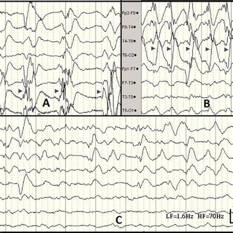 The Patients Electroencephalography Eeg Showing Bilateral