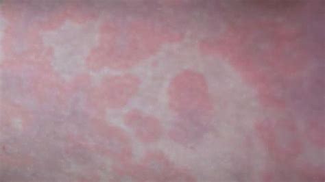 Hives Causes Risks Prevention And Pictures Hives Hives Causes Skin