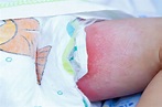 Pics Of Diaper Rash: Understanding The Common Skin Condition In Babies ...