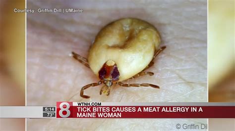 Tick Bite Causes Meat Allergy In Maine Woman Youtube