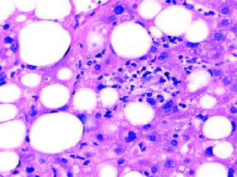 Liver Histology Showing Macrovesicular Steatosis In A Subject With