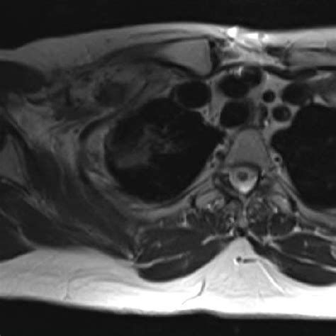 Pdf Significant Fibrosis After Radiation Therapy In A Patient With