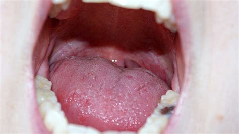 Oral Rinses Could Help Monitor Patients With Hpv Linked Throat Cancer