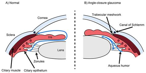 Increased posterior chamber pressure causes iris to bulge forward (iris bombé) → further obstruction of outflow tract → further increase iop. Angle closure glaucoma causes, risk factors, diagnosis ...