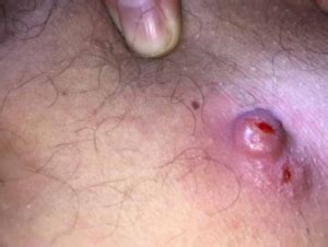 This creates a pus pocket that may become a cyst, referred to. Ingrown Hair Lump, Cyst, Bump, Under Skin, on Neck, Armpit ...